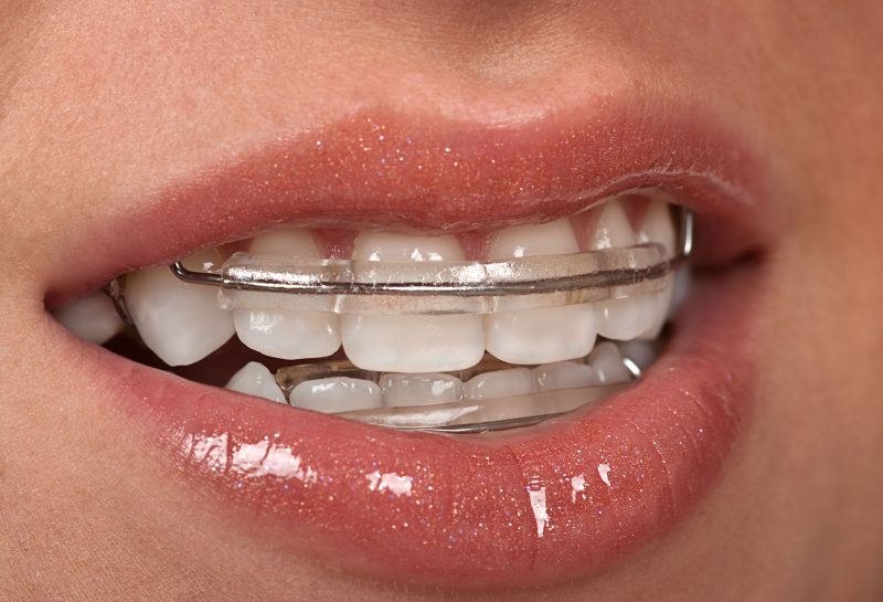 4 Things to Know about Invisalign